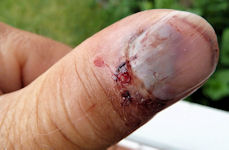 Blessure le m&ecirc;me jour